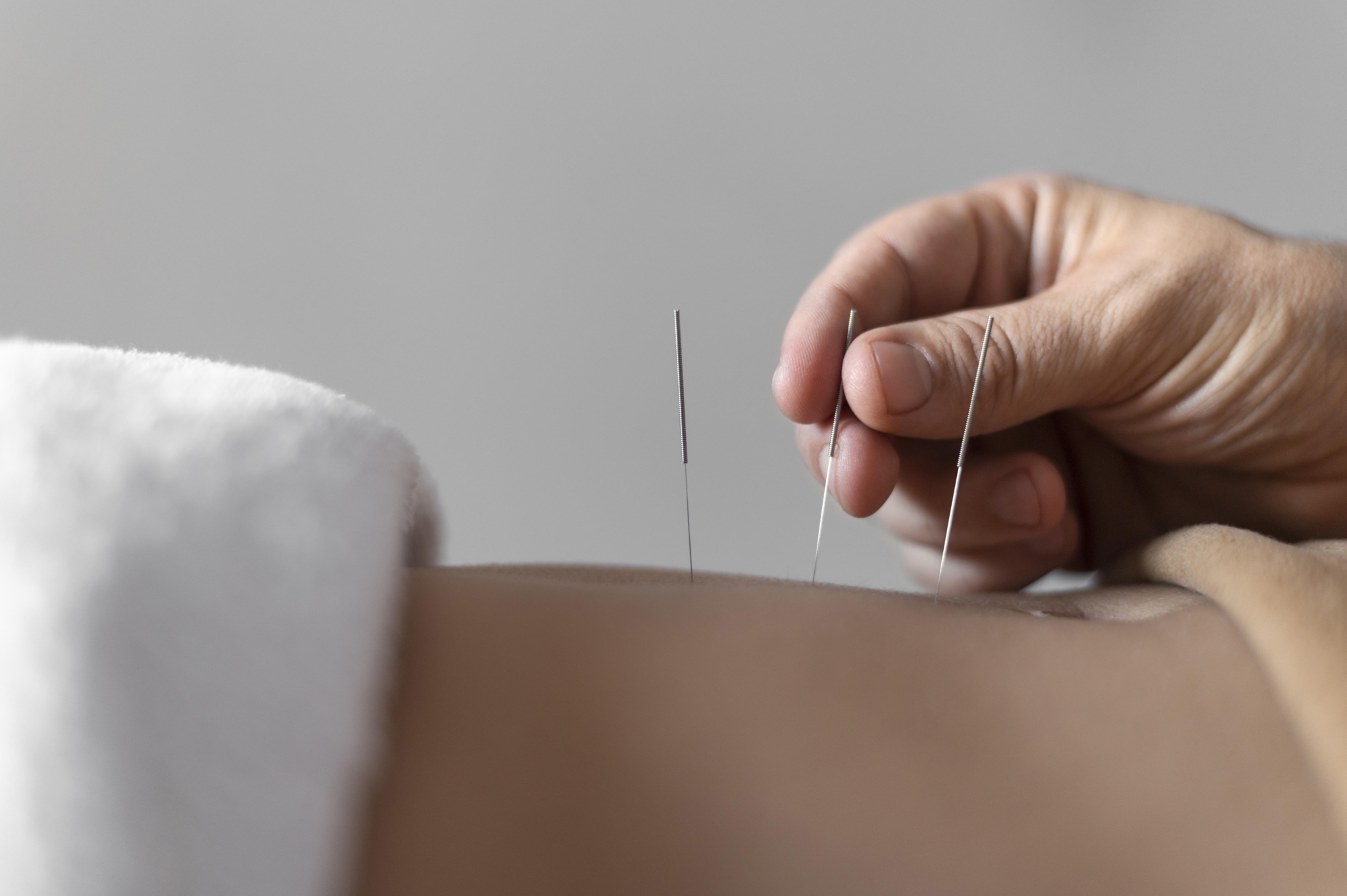 Dry Needling in Brisbane