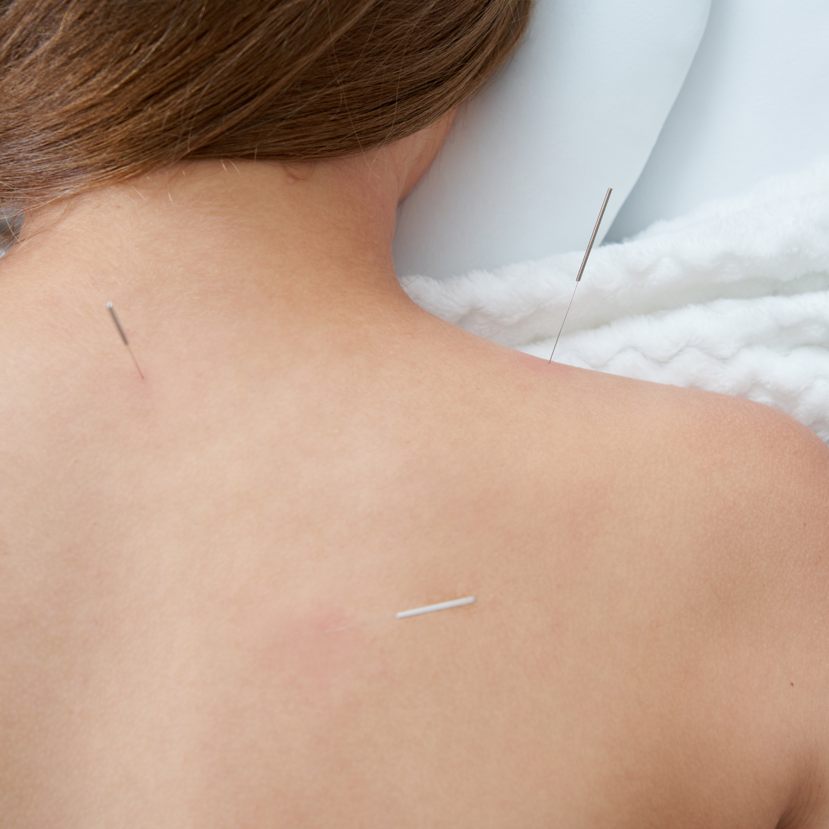 Benefits of Dry Needling